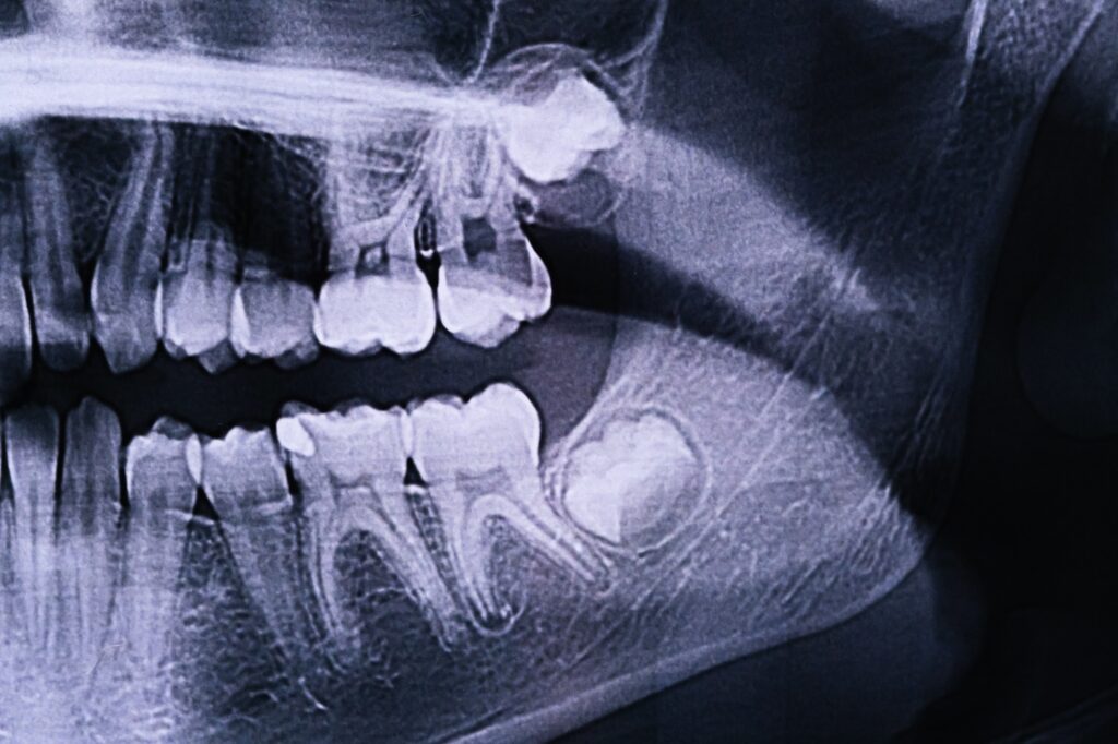 Panoramic X-ray of the jaw. X-ray of the teeth of a 12-year-old girl