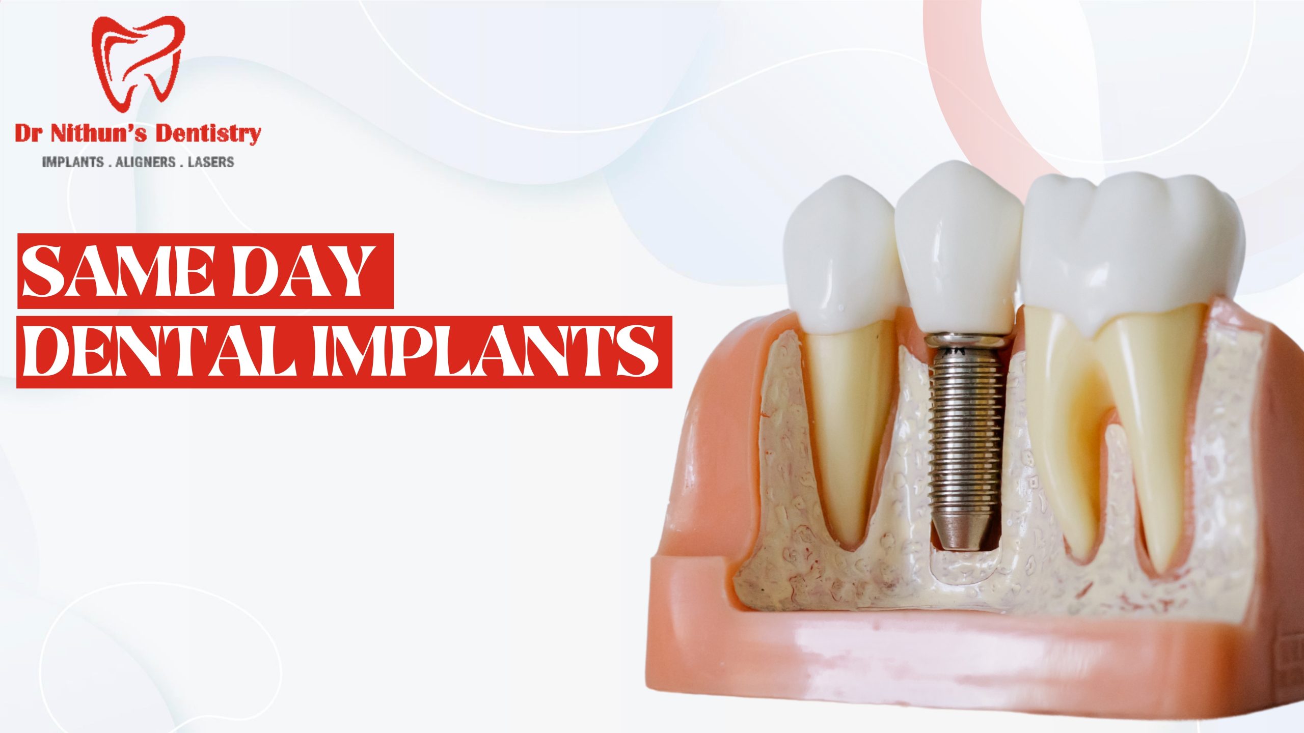 Are Same-Day Dental Implants Possible? | Best Dental Implants in Kompally