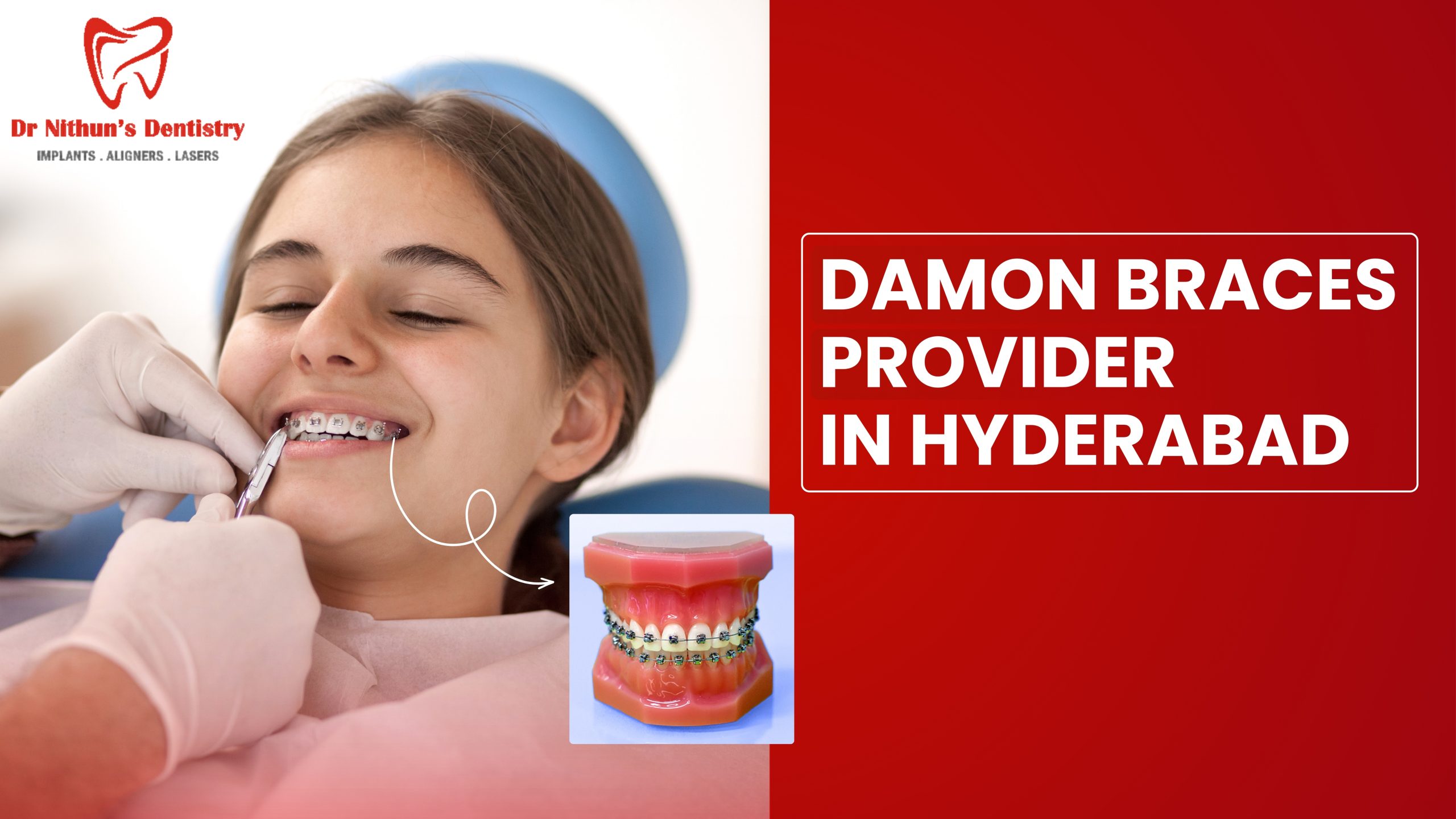 Are Damon Braces Really Faster? What You Should Know Before You Decide