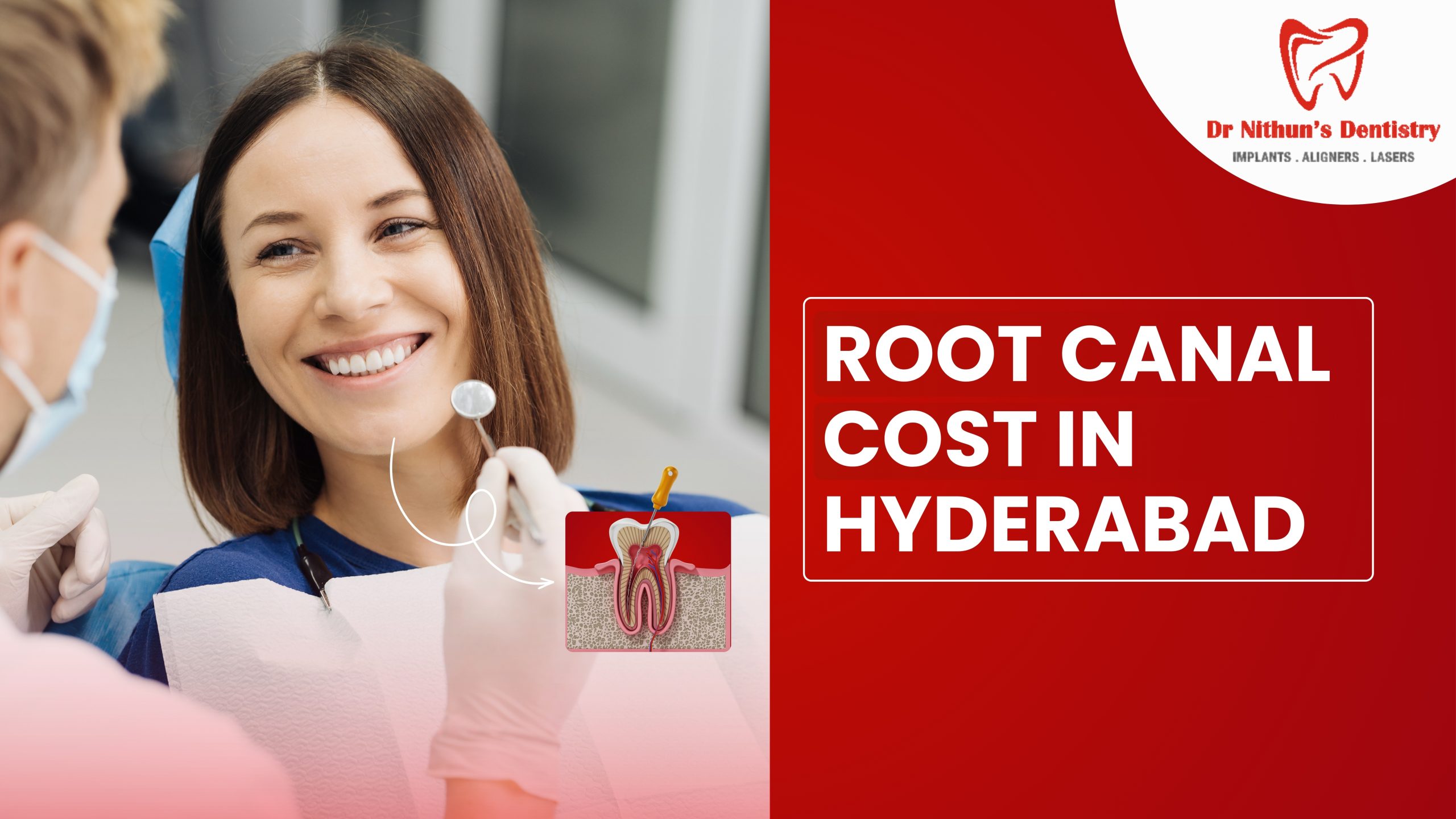 Root Canal Cost in Hyderabad: Detailed Price Breakdown