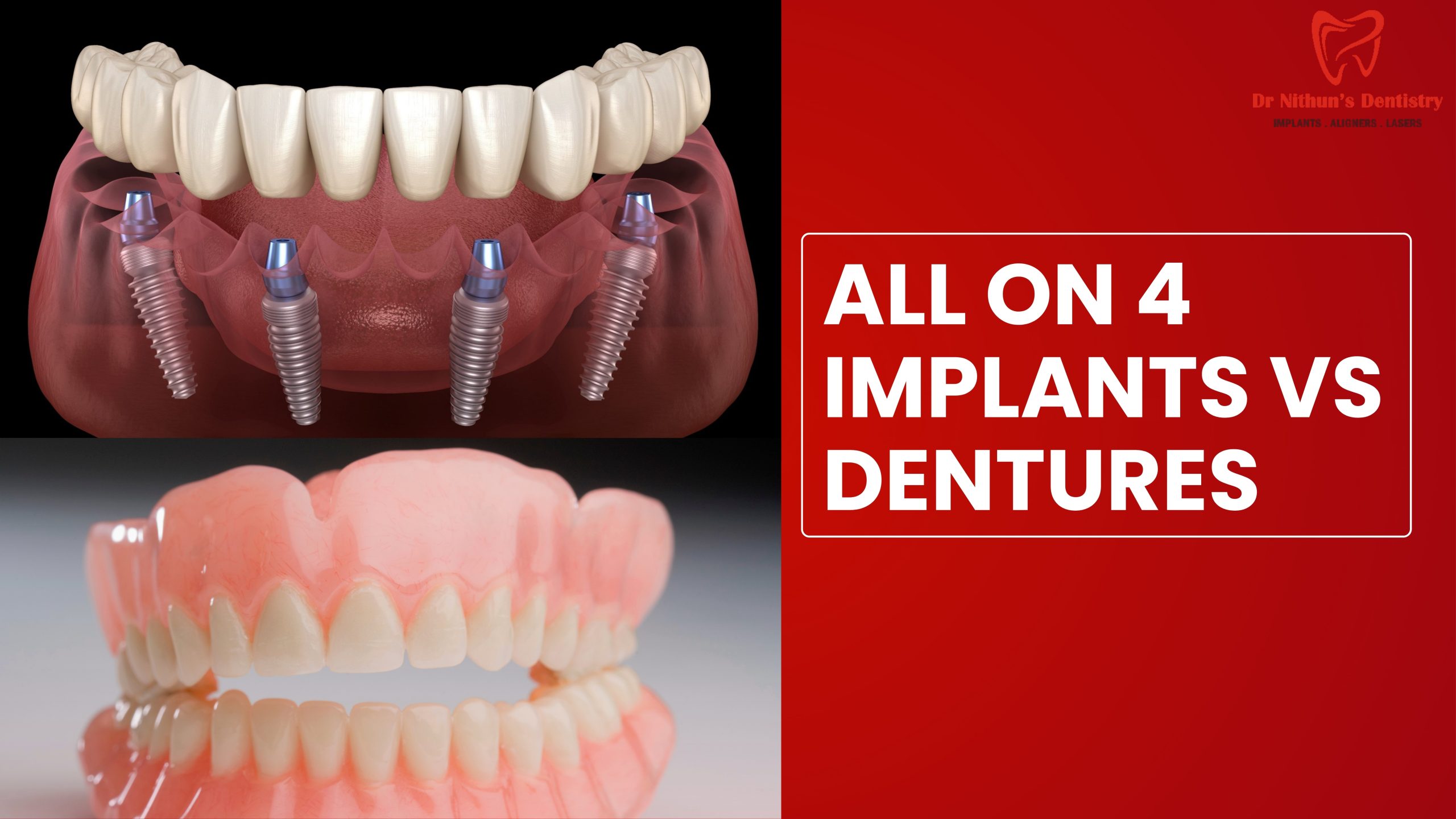 All-on-4 Implants vs Traditional Dentures: What Works Better?
