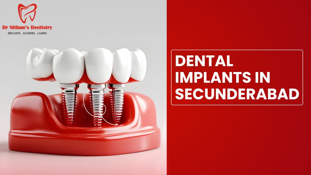 dental implants in secunderabad
