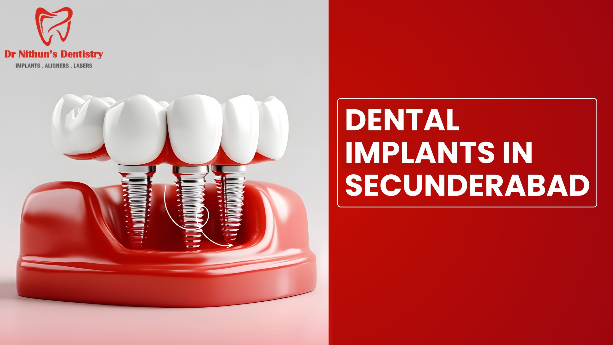 Dental Implants in Secunderabad: Types, Procedure, Cost & Benefits