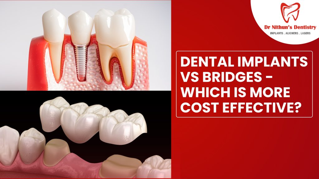 dental implants vs bridges