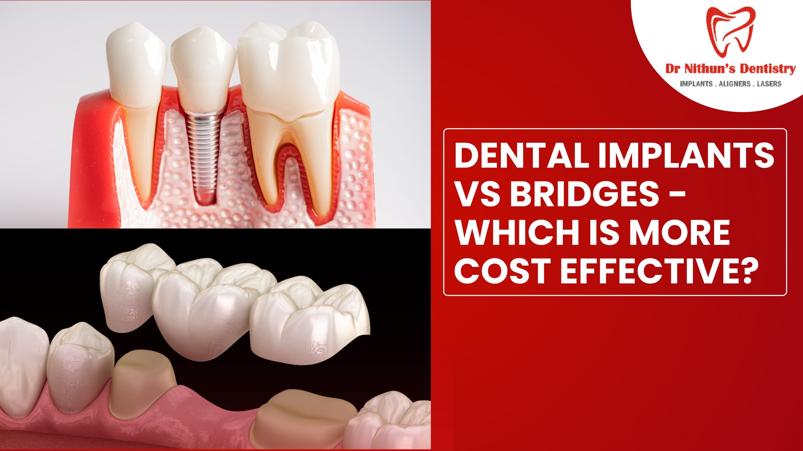 Dental Implants vs Bridges: Which Is More Cost-Effective?