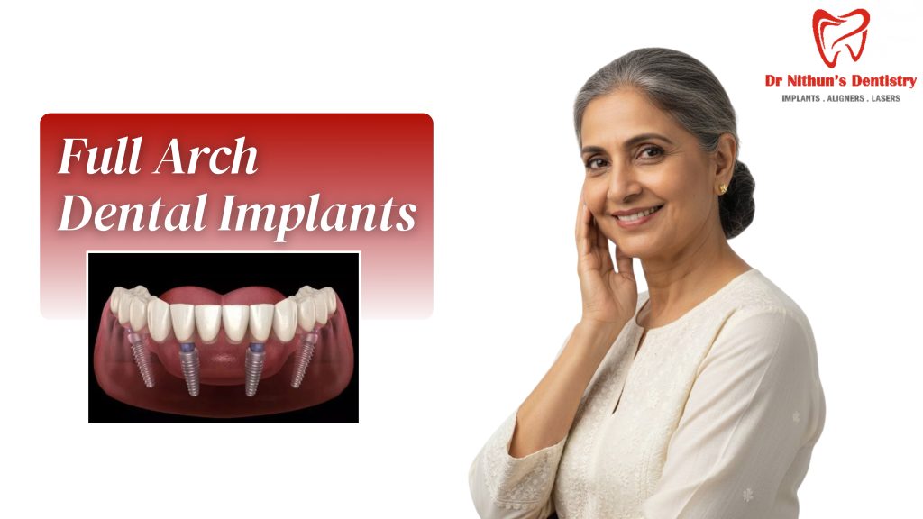 full arch dental implants