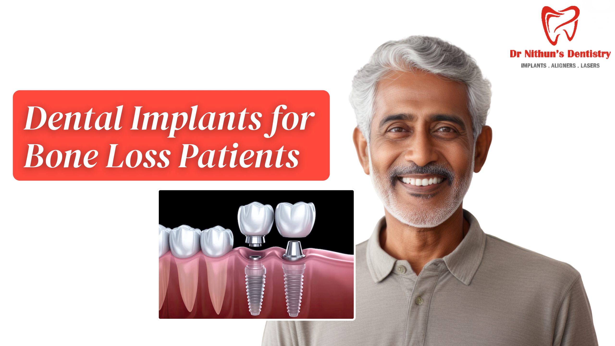 Dental Implants for Bone Loss Patients