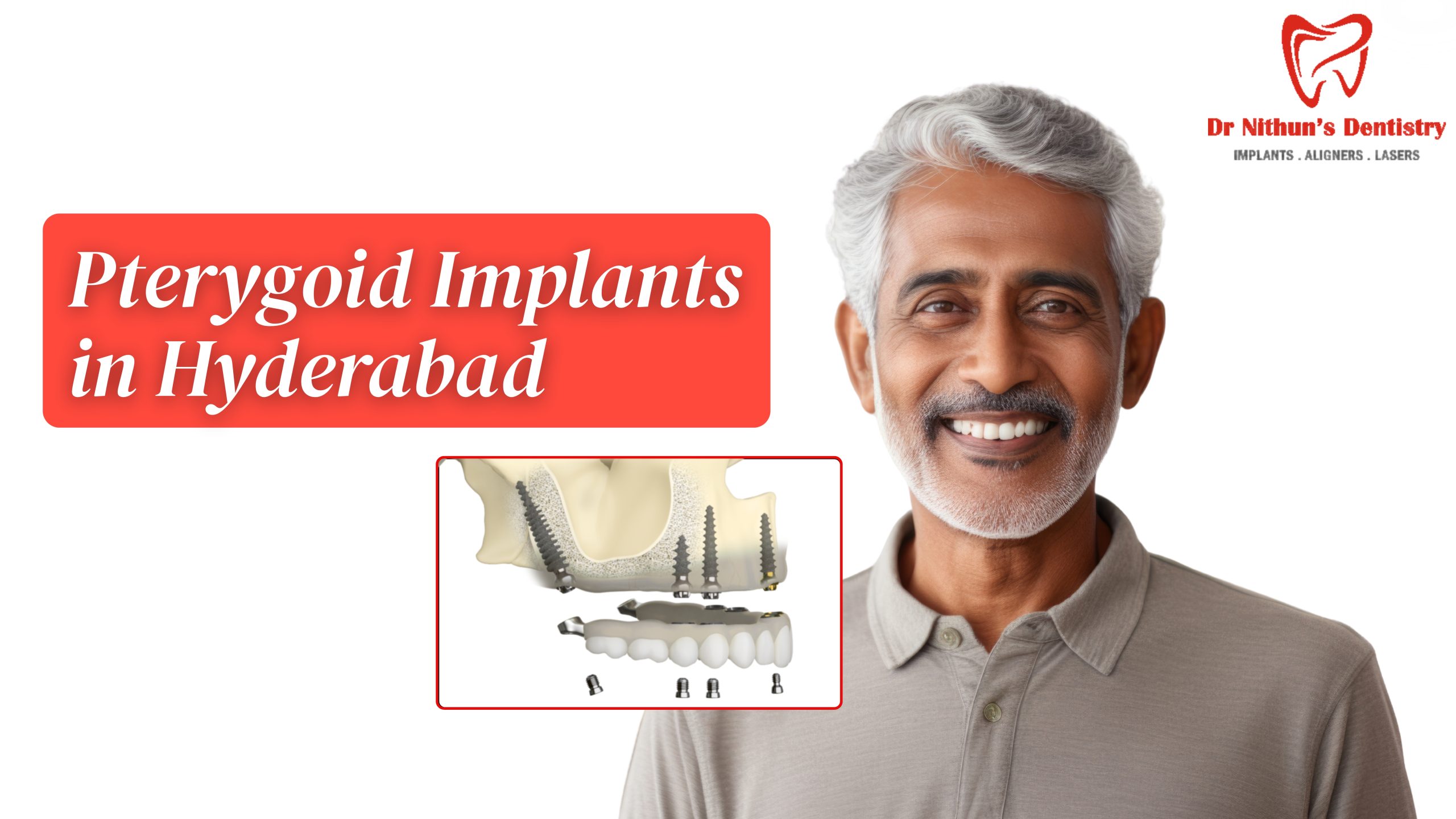 Pterygoid Implants in Hyderabad – Procedure & Benefits